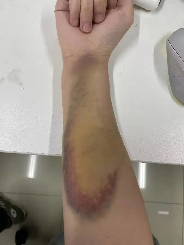 为救轻生女孩，这名研究生胳膊被咬出淤青！还好......